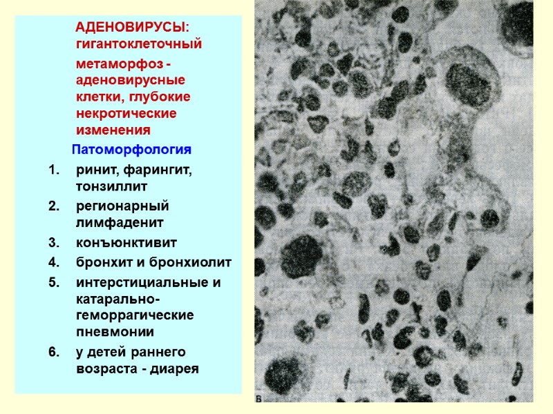 АДЕНОВИРУСЫ:  гигантоклеточный        метаморфоз -аденовирусные клетки, глубокие